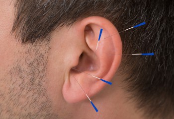 Close-up Of Acupuncture Needles On Man's Ear